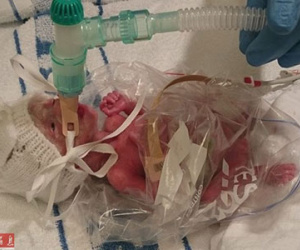 "Cô bé hạt tiêu" nặng 0,5kg sống sót kỳ diệu nhờ túi đựng bánh mì