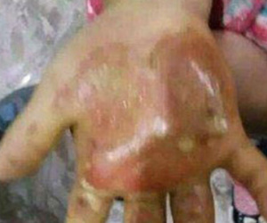 Sục sôi dư luận: Bé 6 tuổi bị mẹ và tình nhân tra tấn như kẻ thù