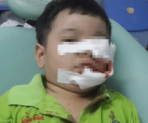 Dồn dập trẻ bị chó cắn nát mặt: Nguy hiểm rình rập