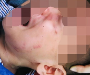 "Bạn bốn chân" cắn trẻ nát mặt, lòi cả hàm răng