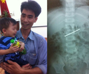 Bé 18 tháng tuổi nuốt đinh vít dài 4,5cm vào bụng