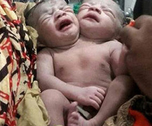 Bé sơ sinh hai đầu chào đời ở Bangladesh