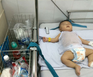 Bé trai bị đâm xuyên sọ nhập viện vì viêm màng não