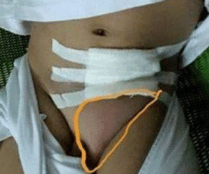 Bé 2 tuổi bị mổ “nhầm” do bác sĩ chẩn đoán sai