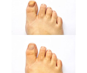 Lạnh chân - dấu hiệu bệnh tim mạch