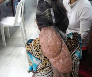 Cụ bà mang khối u hình thù quái dị ở sau gáy