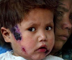 IS đang gieo rắc vi trùng ăn thịt người khắp Syria?
