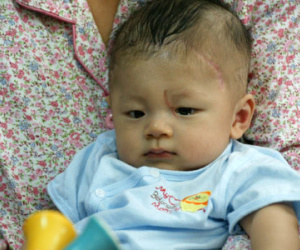 Bé bị đâm xuyên sọ sốt trở lại sau một tuần khỏe mạnh