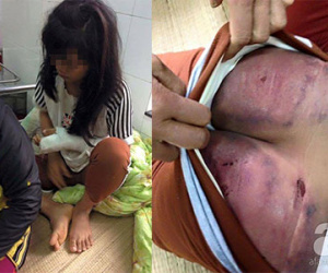 Đau lòng bé gái lớp 9 kêu cứu vì bị cha ruột đánh gãy tay, dập nát mông