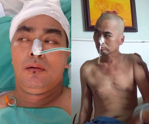 Nguyễn Hoàng cử động được tay phải sau hơn một tháng mổ não