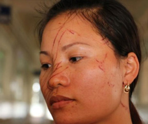 Hai mẹ con bị hàng xóm rạch mặt dã man