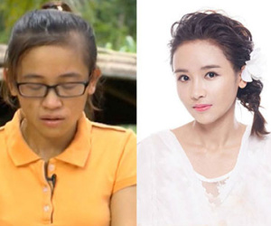 Nữ sinh ĐH Y: "Phẫu thuật thẩm mỹ đã thay đổi cuộc đời tôi"