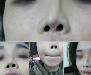 Cô gái Hà Nội bế tắc vì đã 2 lần đau đớn thẩm mỹ nhưng mũi vẫn... lệch