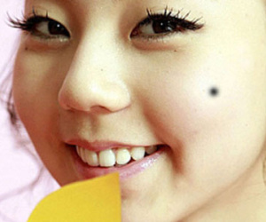 Nốt ruồi chảy máu, coi chừng ung thư