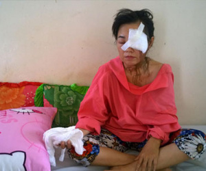 Vợ bị chồng cũ thuê người tạt axit: “Thà anh ta cứ đánh chửi tôi thế nào cũng được..."
