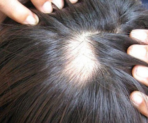 Xài "thần dược" chống hói, lông lá mọc đầy người