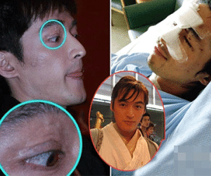 Nam diễn viên bị khâu hơn 100 mũi sau tai nạn kinh hoàng