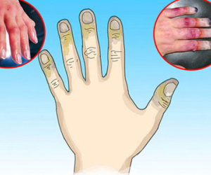 Bỏng lạnh "ăn mòn" bạn đau đớn thế nào?