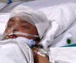 Bé gái 3 tuổi bị vợt cầu lông đâm xuyên não