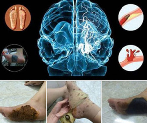 Sự thật bài thuốc dùng 1 lần cứu hàng nghìn người thoát đột quỵ