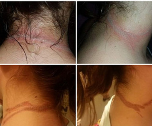 Sự cố bất ngờ từ chiếc điện thoại di động khiến cô bé 13 tuổi mang sẹo suốt đời