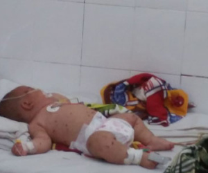 Bé trai 5 tháng tuổi nghi nhiễm não mô cầu