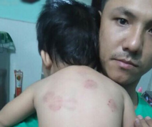 Bé gái 13 tháng tuổi bị bạn cắn chi chít vết thương, chủ trường gọi phụ huynh là "Chí Phèo"
