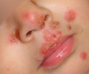 Mụn rộp sinh dục, bệnh lây qua nụ hôn của người lạ