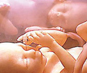 Hai bé sinh đôi "đánh nhau" trong bụng mẹ