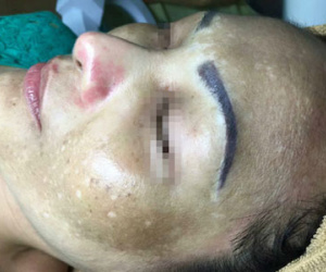 Cẩn trọng với kem ốc sên làm trắng da siêu tốc