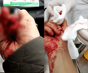 Nhà báo Đỗ Doãn Hoàng bị ba đối tượng lạ mặt dùng gậy đánh dã man