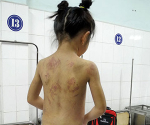 Bé 8 tuổi bị mẹ kế đánh đập lằn roi khắp người