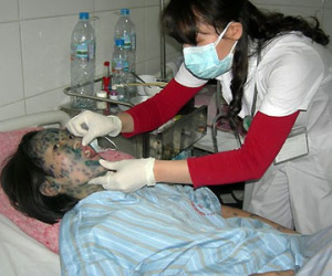 Cảnh giác với bệnh thủy đậu vào mùa