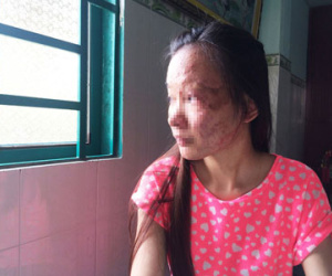 Nữ sinh viên bị tạt axit: Nỗi đau ở lại mãi mãi trên khuôn mặt