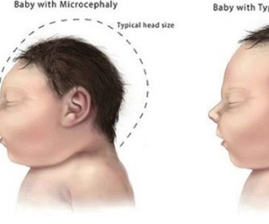 Thai phụ nhiễm virus Zika tại VN: Liệu thai nhi có "gặp nguy"?