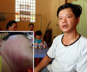 Nghi án cô giáo mầm non đánh trẻ bầm mặt