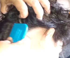 Hình ảnh phát buồn nôn về người "nuôi" hàng ngàn con chấy trên đầu