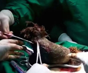 Lấy ra búi tóc nặng gần 1 kg trong bụng bé gái 17 tuổi