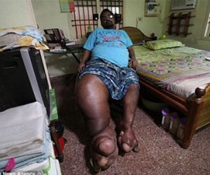 Mắc bệnh lạ, người đàn ông có bàn chân nặng... 100kg