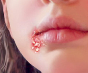 Mắc bệnh lây truyền đường tình dục không do quan hệ