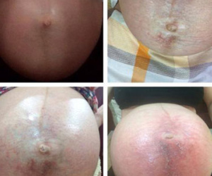 Mẹ bầu tuyệt vọng với bụng bầu mưng mủ