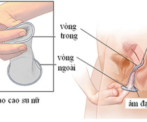 Bao cao su cho phái nữ, bảo bối giúp tránh thai và ngừa bệnh tình dục