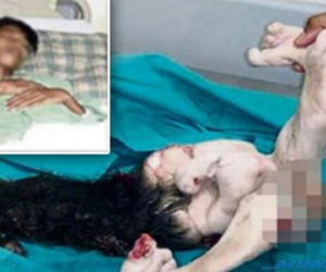 Cậu bé mang bào thai ký sinh trong dạ dày suốt 15 năm