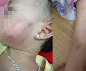 Hà Nội: Bé gái 16 tháng tuổi thâm tím mặt và tay sau khi đi học ở trường mầm non về
