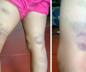 Sa thải cô giáo đánh tím chân học sinh vì viết sai chính tả