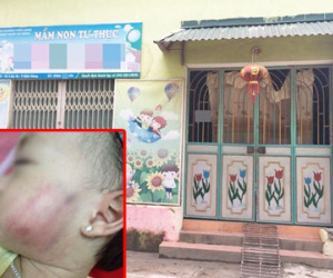 Tạm dừng hoạt động trường mầm non sau vụ bé gái bị sưng tím mặt