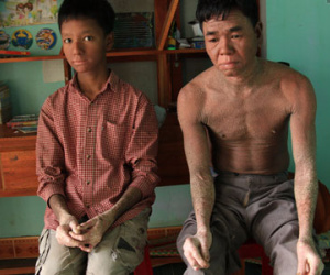 Cậu bé "người rắn" ở Quảng Nam: Hồi trước các bạn bỏ chạy vì sợ, nhưng giờ nhiều bạn thân với con lắm"
