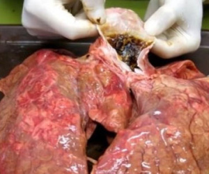 Hút thuốc lá dễ chết sớm hơn 20 năm