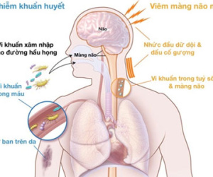 Dấu hiệu cảnh báo bệnh viêm não mô cầu