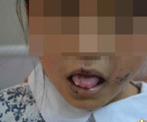 Bé 10 tuổi Trung Quốc bị mẹ nuôi kẹp lưỡi, cắt tai
